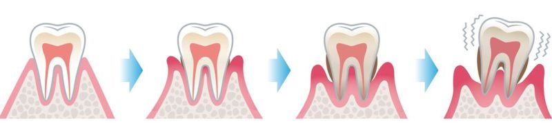 Parodontális tasakok kialakulása