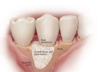 csontpotlas, dentalux, fogbeultetes, fogaszat, ruzs es mas, fog, implantatum, fog implant, fogpotlas