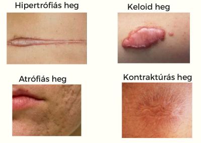 heg, hegkezeles, sherlock rehab, egeszseg, fascia, ruzs es mas